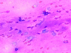 neoplastic cells