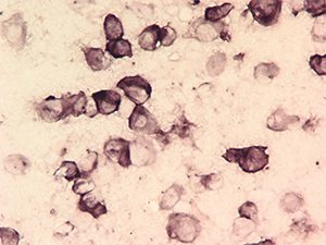 Osteosarcoma