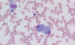 Osteoblasts with eccentrically placed nuclei and perinuclear clearing.