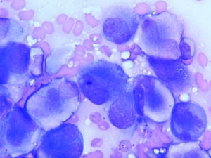 Osteosarcoma