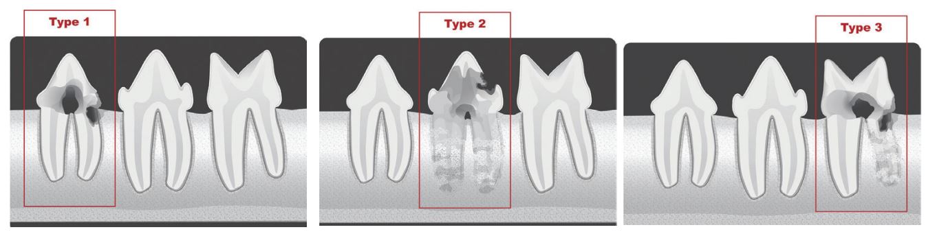 Feline Tooth Resorption Treatment Options Veterinary Medicine At