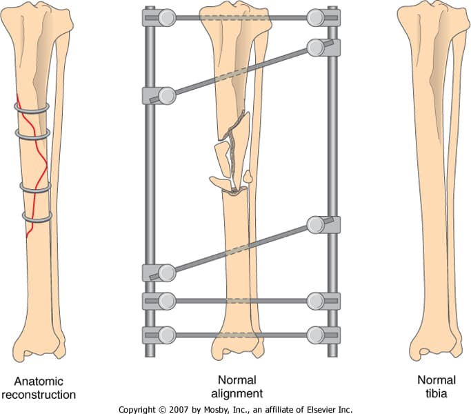 Tibula - Fibula break