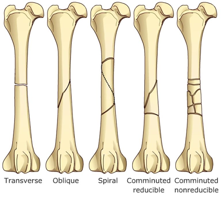 Fracture Planning – All-in-one Ortho-online