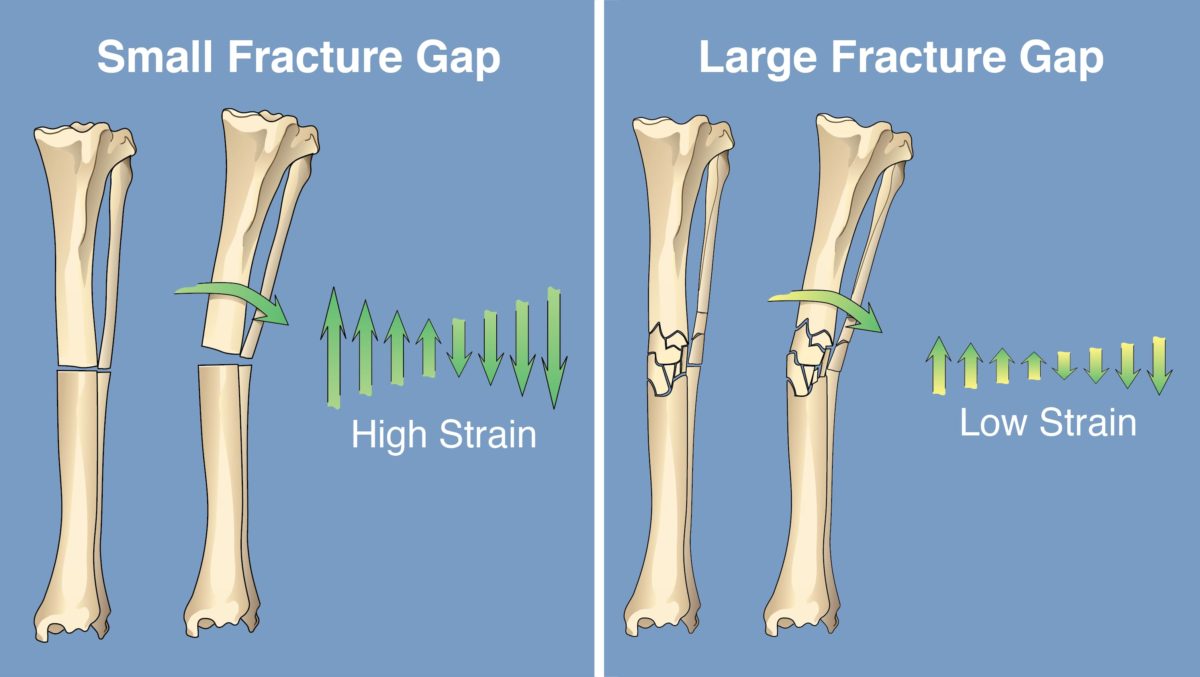 Fracture Healing – All-in-One Ortho-online