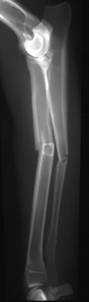 case 1 pre-op radiograph tibia lateral