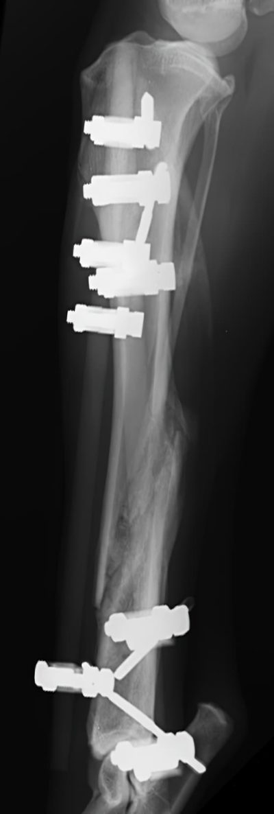 case 3: 6 week Post-op radiograph lateral view