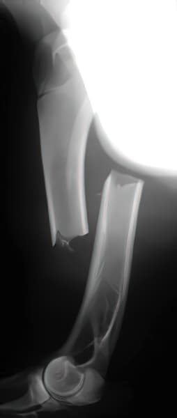 case 4: Pre-op radiograph lateral view