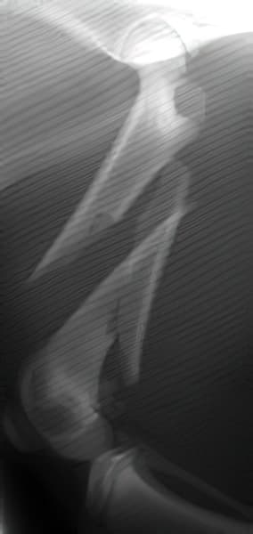 case 5: Pre-op radiograph lateral view