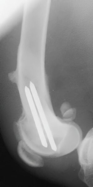case 6: 6 week Post-op radiograph lateral view