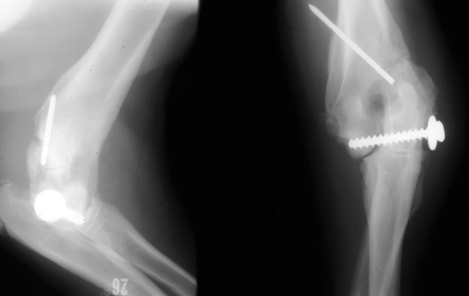 case 8: 6 week followup right humerus