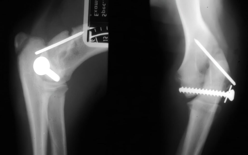 case 8: Post-op right humerus
