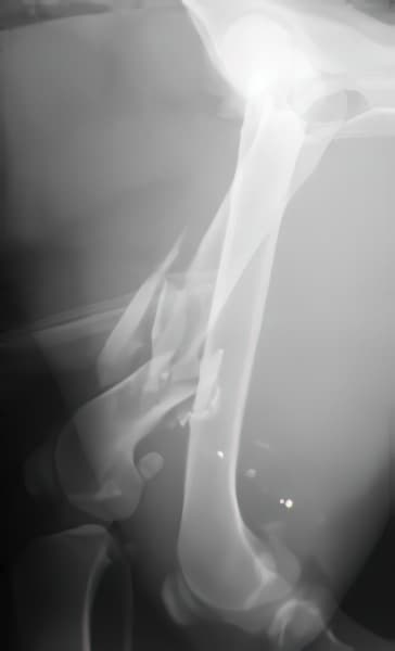 case 10: Pre-op radiograph lateral view
