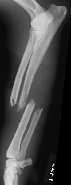 case 12: Pre-op radiograph lateral view