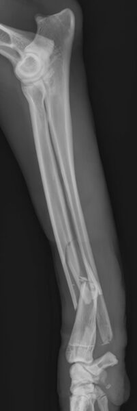 case 22: Pre-op radiograph lateral view