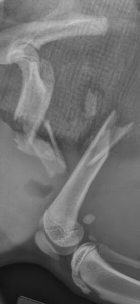 case 23: Pre-op radiograph lateral view