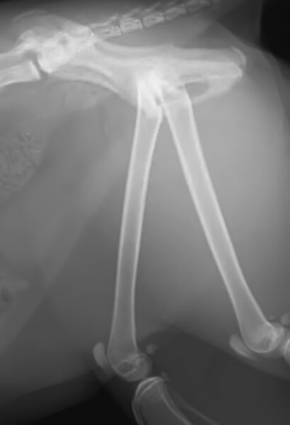 case 25: Pre-op radiograph lateral view
