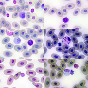 LEWS hematology