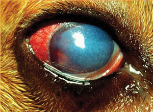 Eye Glaucoma