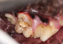 carious lesions on maxillary first molar