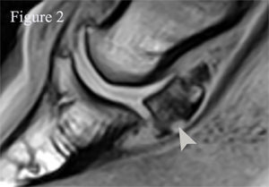 Sagittal T1GE weighted image