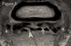 Transverse T1GE weighted image