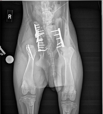 [radiograph (X-ray) of Spike's fractured pelvis after surgery]