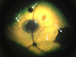 [cat's eye with fungal plaques]