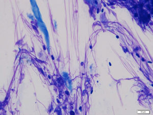 Impression smear cytology from a dog with Malassezia 