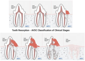 Feline Tooth Resorption: Treatment Options - Veterinary Medicine at ...