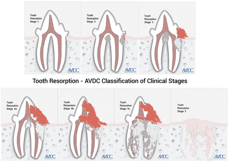 Feline Tooth Resorption Treatment Options Veterinary Medicine at