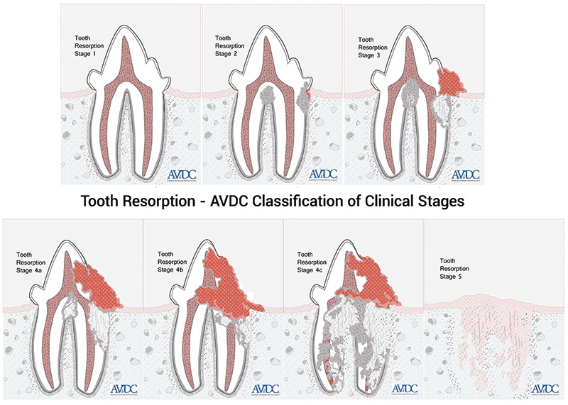 Feline Tooth Resorption Treatment Options Veterinary Medicine