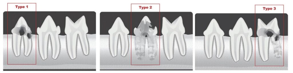 Feline tooth resorption outlet treatment