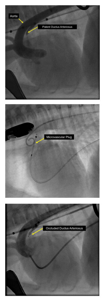 Fig. 1. Aortic angiogram (injection of contrast) that illustrates left-to-right shunting flow from the descending thoracic aorta through a very small patent ductus arteriosus (PDA) in one of our patients undergoing PDA occlusion with the MVP device. Fig. 2. Intra-operative image of the MVP device just before deployment across the PDA. Fig. 3. Intra-operative angiogram with the MVP device positioned across the ductus arteriosus demonstrating complete occlusion of the defect.