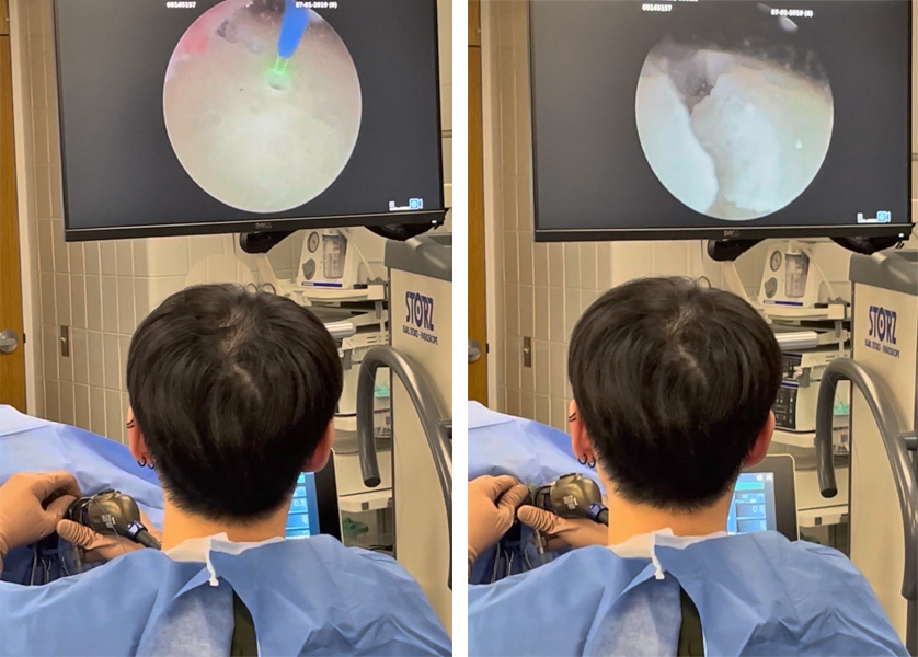 Images of the screen showing a large bladder stone and the tip of the laser that is breaking it apart