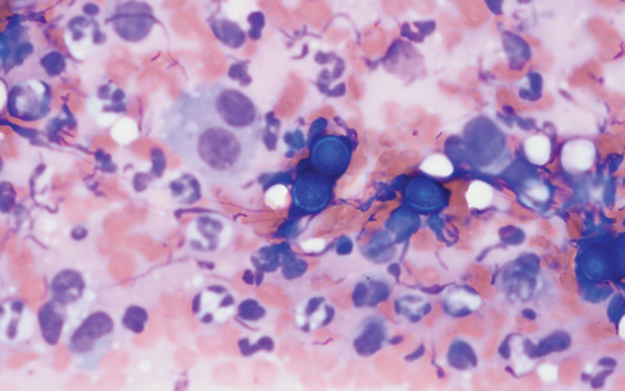 Cytology slide showing Blastomyces